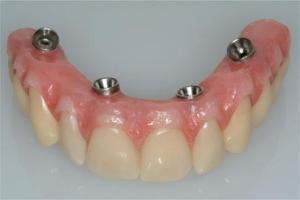Screw retained restoration prototype showing top teeth