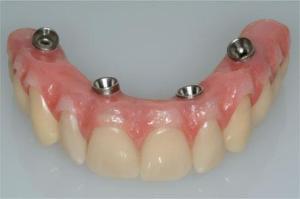 Screw retained restoration prototype showing top teeth