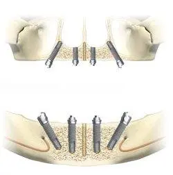 Diagram of a screw retained restoration back view
