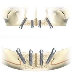 Diagram of a screw retained restoration back view