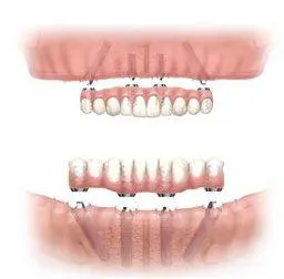 Diagram of a screw retained restoration front view 