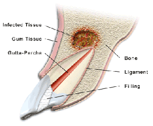 apicoectomies diagram